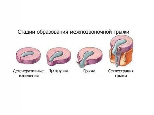 Лечение межпозвонковых грыж позвоночника в домашних условиях