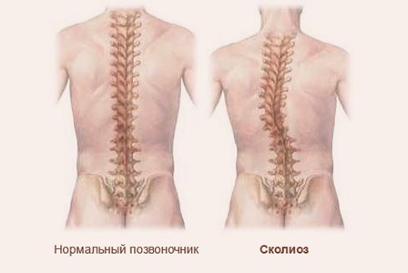 Искривление позвоночника лечение у ребенка 6 лет