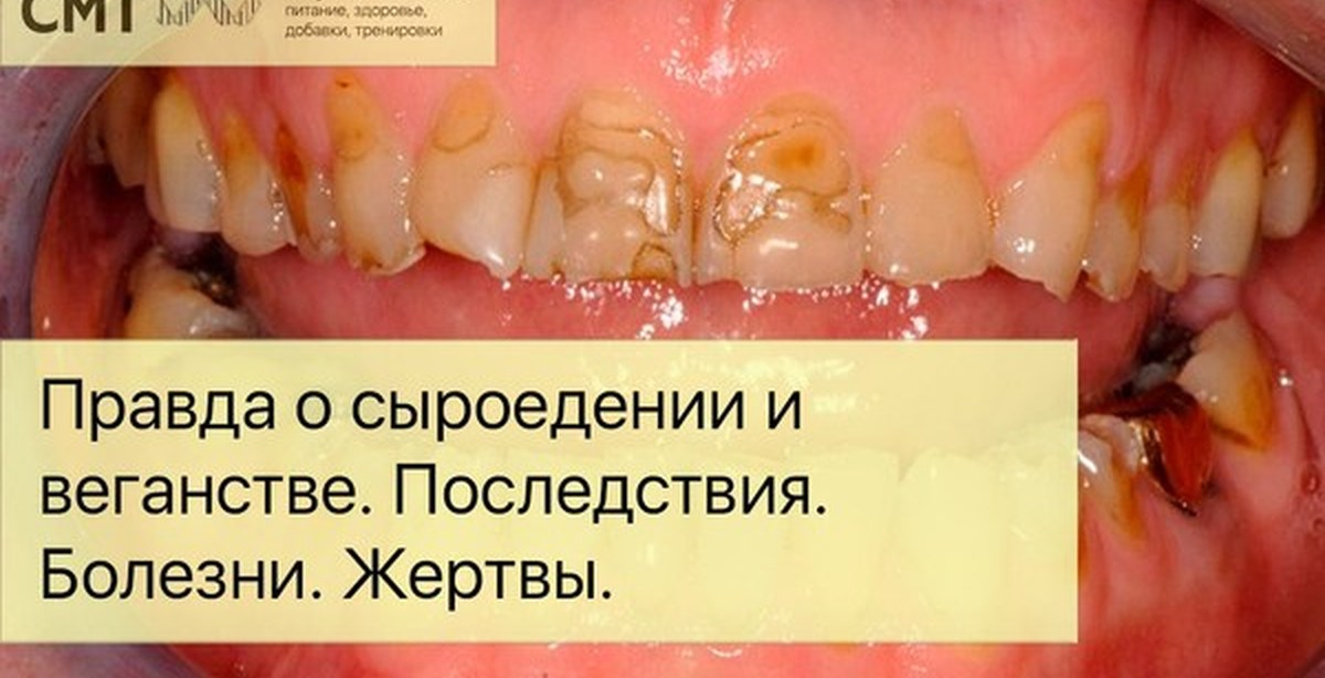 Как быть с зубами на сыроедении Как быть с зубами на сыроедении