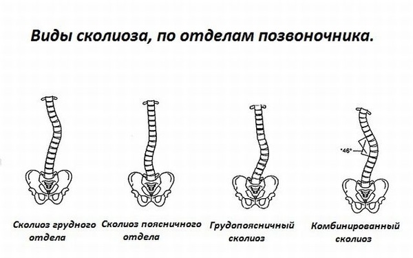 Сколиоз на фоне остеохондроза