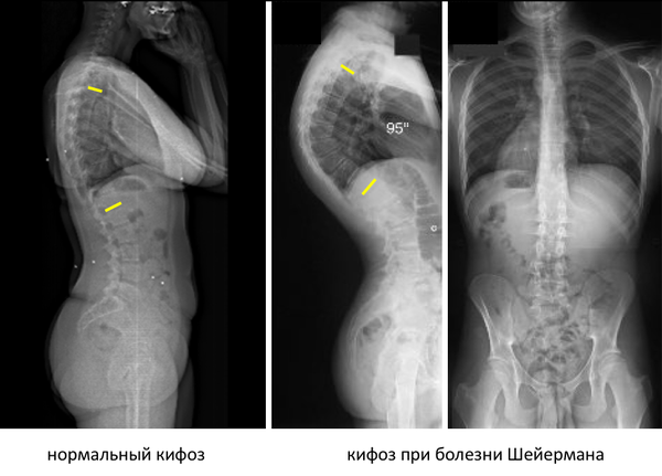 Болезнь шейермана фото