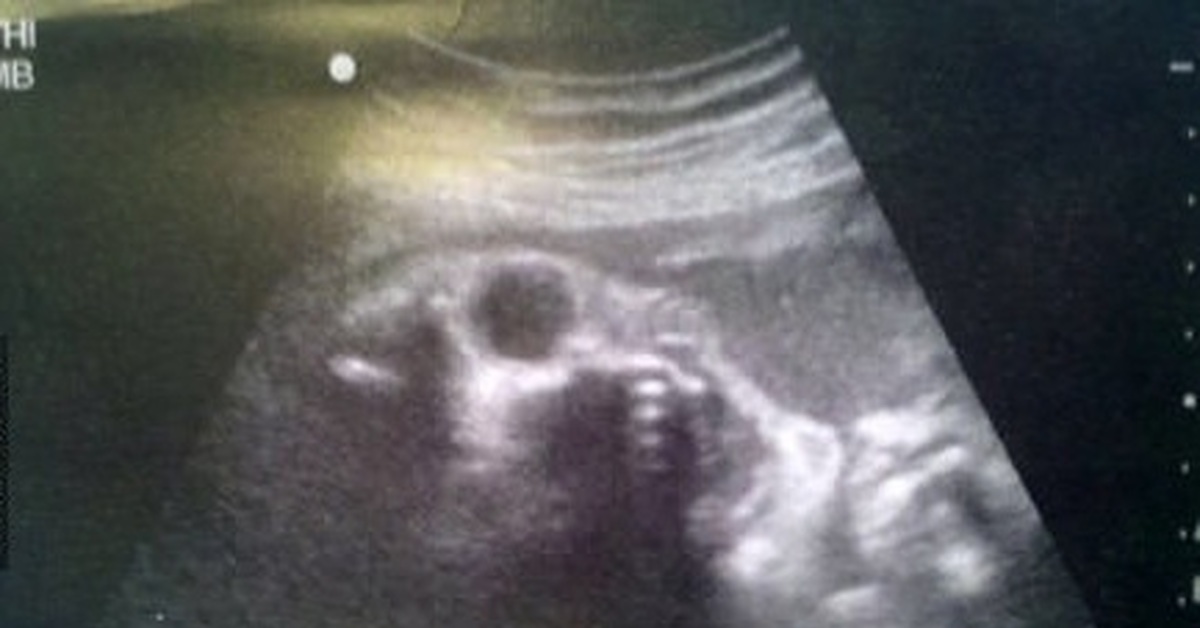 Мальчик 20 недель беременности. УЗИ 17 недель беременности мальчик. Ребёнок в утробе матери УЗИ. Страшные снимки УЗИ беременных.