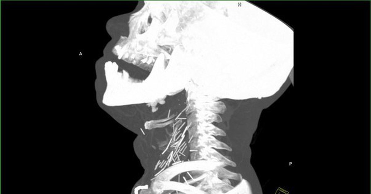 Глубокое горло. Перелом подъязычной кости рентген. Перелом подъязычной кости снимок рентген. Подъязычная кость рентген.