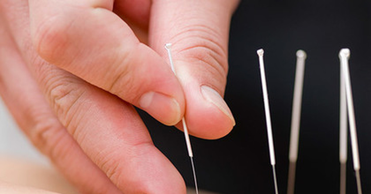 Иглоукалывание в кирове. Рефлексотерапия. Корпоральная иглорефлексотерапия. Иглоукалывание тибет. Иглорефлексотерапия.