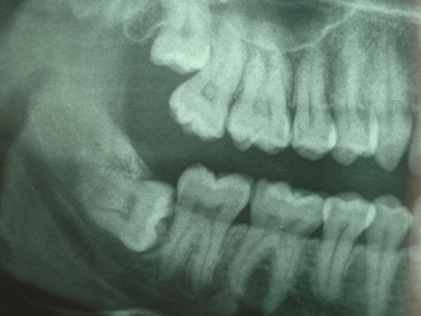 Wisdom tooth - My, Wisdom tooth, Operation, Pain