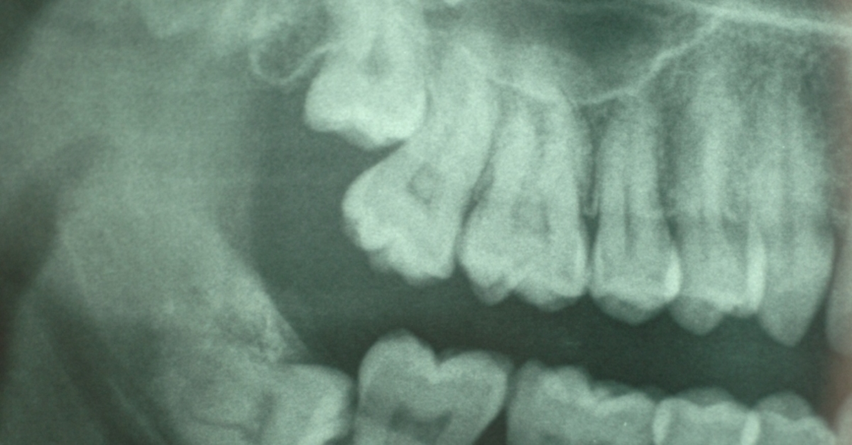 Зуб 8 корень. Третий моляр («зуб мудрости»): нижней челюсти. Ретинированный зуб мудрости рентген. Перикоронит рентгенограмма. Зуб восьмерка на верхней челюсти.