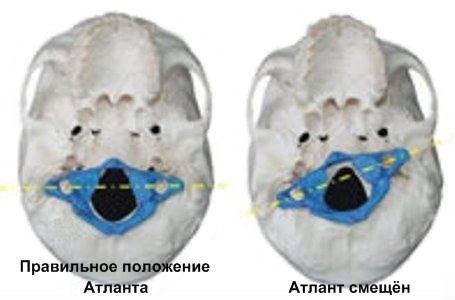 About our valiant doctors or why many are worried about the back. - My, Massage, Doctors, Scoliosis, , Posture, Longpost