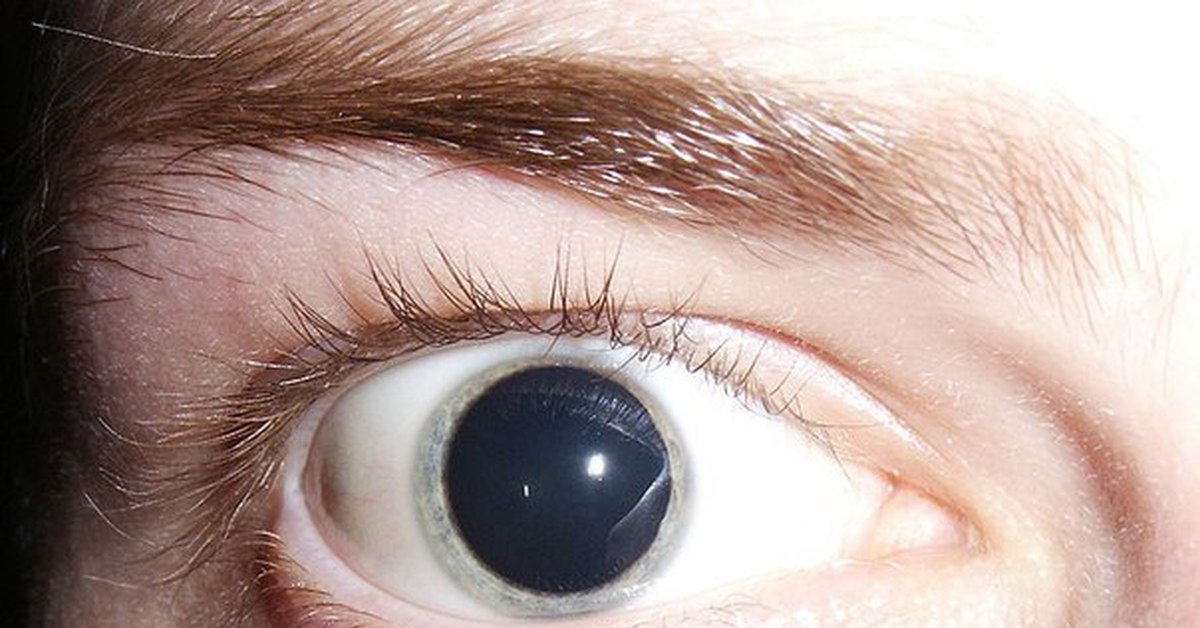 Домашний глаз прямой. Миоз мидриаз анизокория. Мидриаз, нистагм, анизокория.