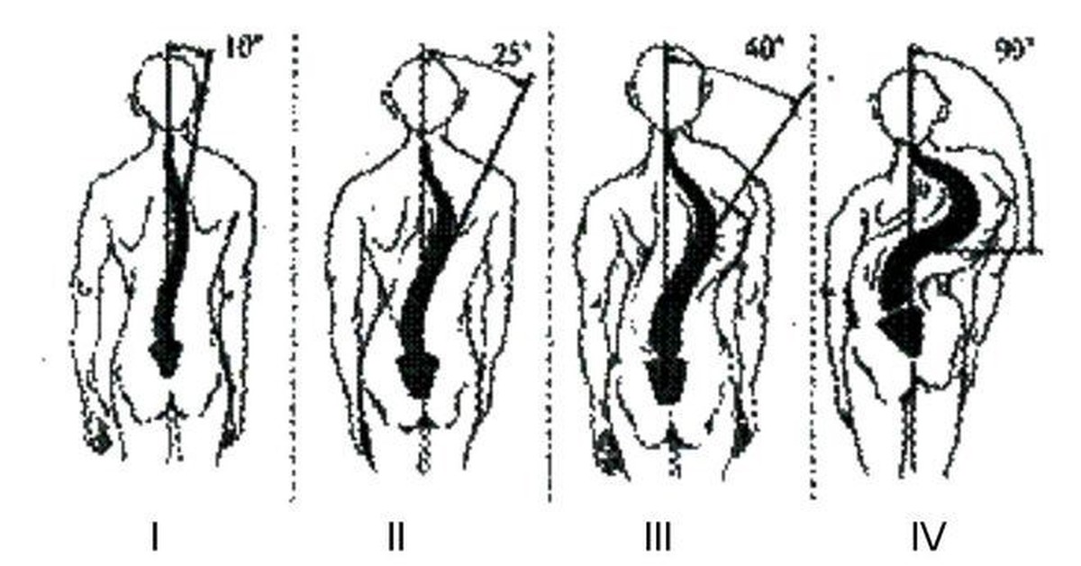 Правосторонний сколиоз 2 степени поясничного отдела. Правосторонний шейно грудной сколиоз. С-образный левосторонний сколиоз. 2 степень s образного сколиоза. Правосторонний сколиоз 1 степени что это.