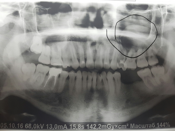 Need help from a doctor! - My, Dentist, What's this?, Cyst, Help