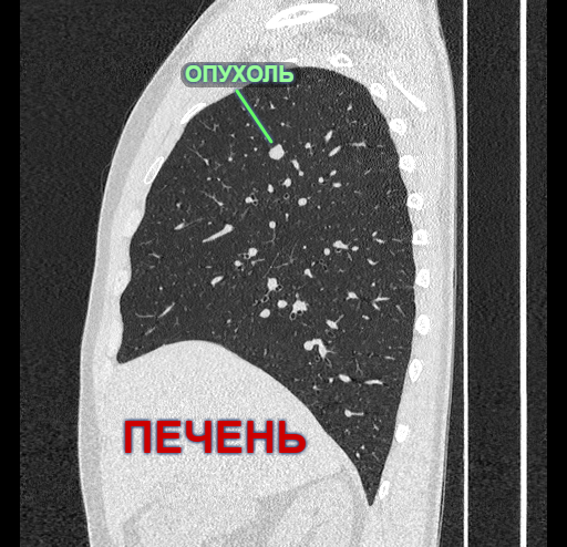 Что в легком? - Моё, Хирургия, Опухоль, Торакальная хирургия, Длиннопост