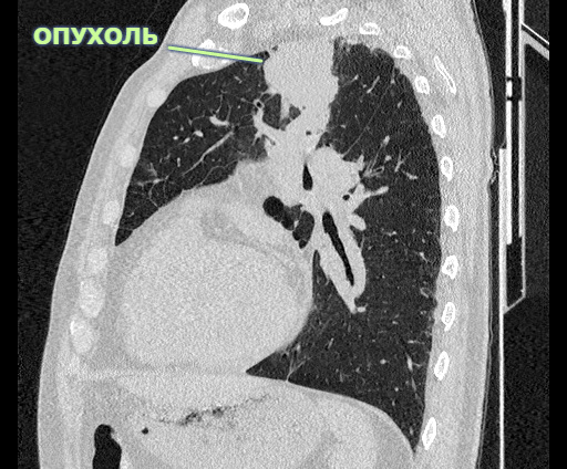 So lung cancer. - My, Oncology, Lung cancer, Longpost, Friday tag is mine, The medicine