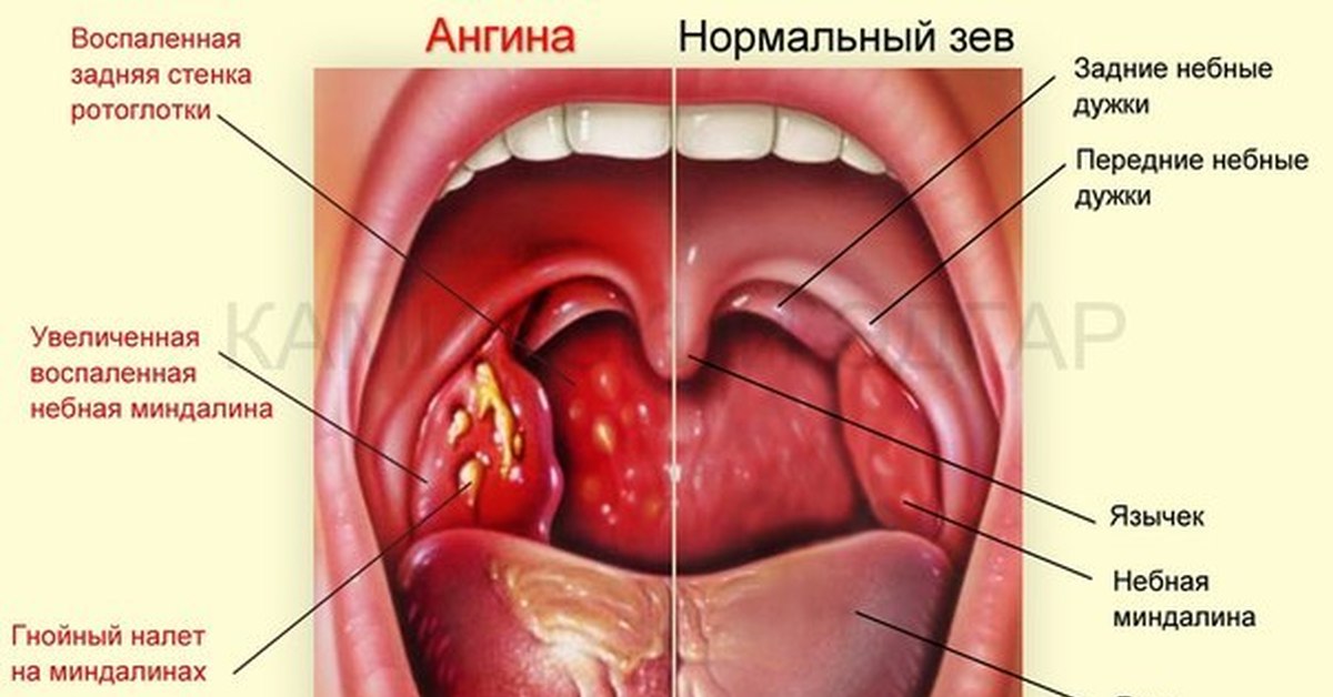 Почему возникает боль в горле?