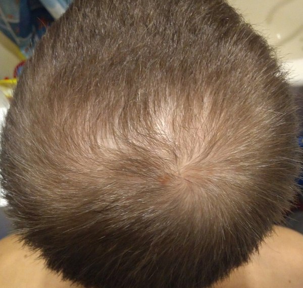 The fight against baldness - My, Baldness, Alopecia, Minoxidil, Bald, Bald spot, Longpost