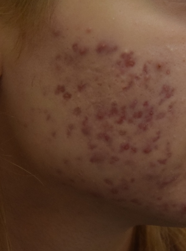Acne. Part 2. Fundamentals of general therapy, the consequences of improper treatment. - My, Acne, The medicine, Moscow, Cosmetology, Scarring, Dermatology, Longpost