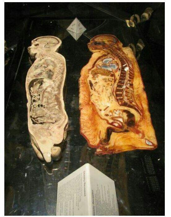 Cross-sectional view of the physique of a normal person and an obese person. - Physique, Incision