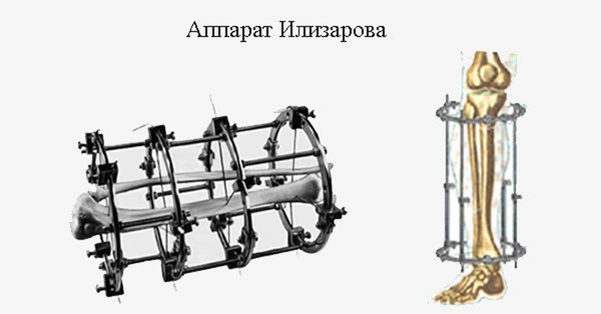 Аппарат илизарова картинки