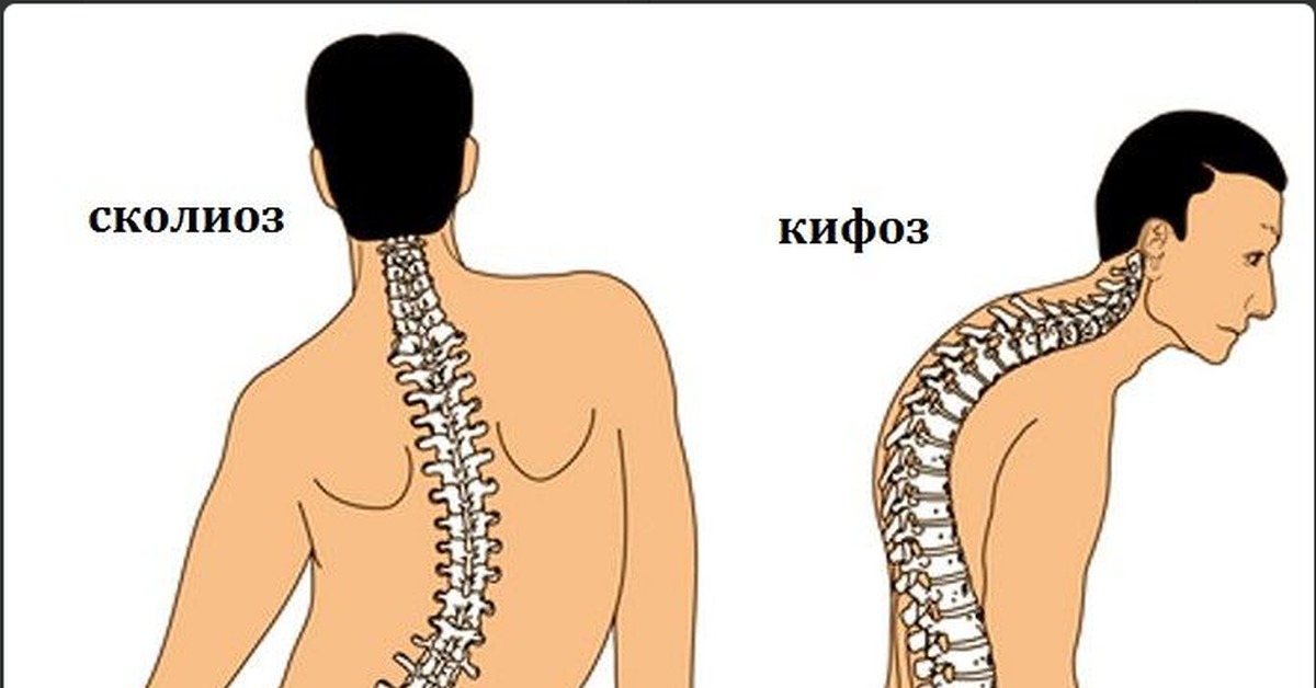 Лордоз кифоз сколиоз картинки