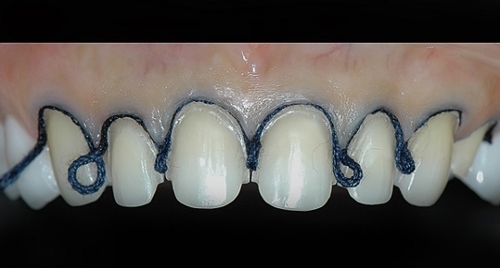 Veneers 5. Half a million smile. Photos! - My, Veneers, Teeth, Dentist, Dentistry, Text, Longpost, beauty