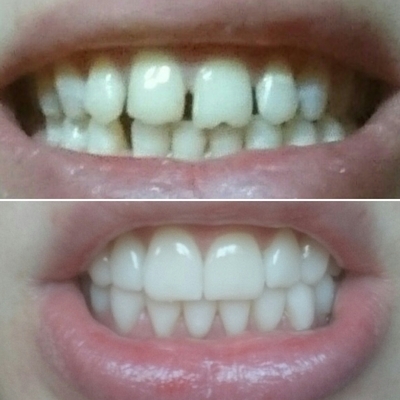 Veneers 5. Half a million smile. Photos! - My, Veneers, Teeth, Dentist, Dentistry, Text, Longpost, beauty