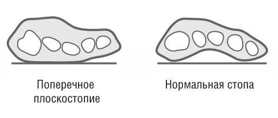 Плоскостопия - херня. (НЕТ!) - Армия, Плоскостопие, Медицина, Военкомат, Длиннопост