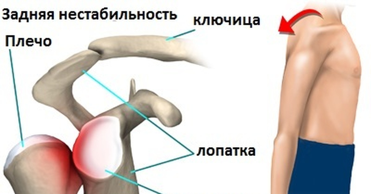 Плечо понять. Нестабильность плечевого сустава. Хроническая нестабильность плечевого сустава. Задняя нестабильность плечевого сустава. Вылетел плечевой сустав.