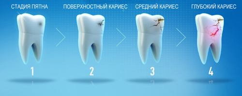 Simple Dentistry. Caries. - , Longpost, The medicine, Facts, Images, Dentistry, The science