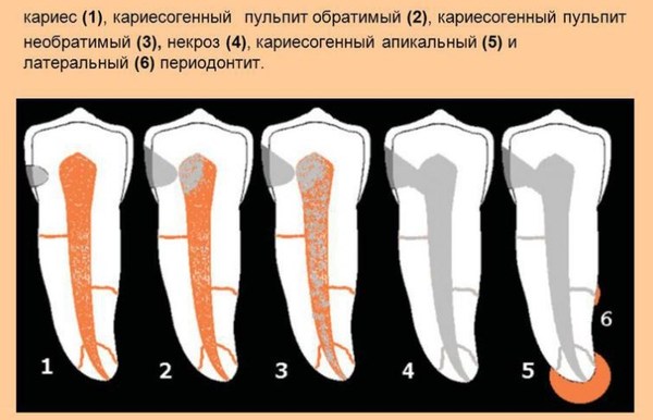 Пульпит зуба картинки