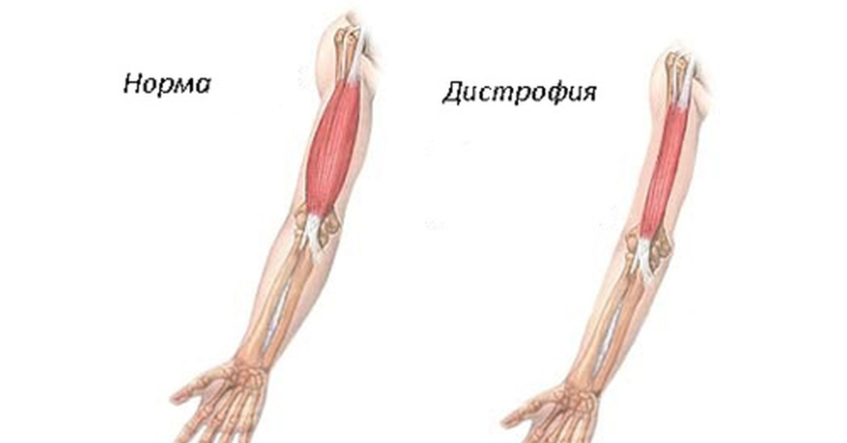 Мышцы нормальные. Дистрофия скелетных мышц. Дистрофия мышечной ткани. Мышечная дистрофия скелетной мускулатуры.