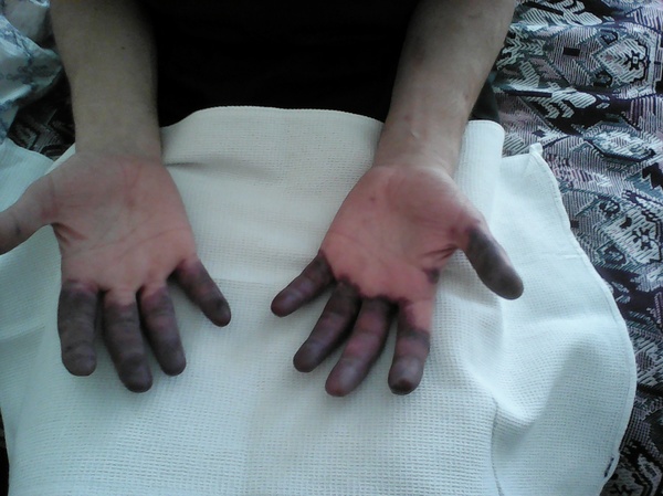 Как мне лечили пневмонию Врачи, Подлог, Непризнают вину, Халатность, Аллергия на лекарства, Росздавнадзор, Длиннопост