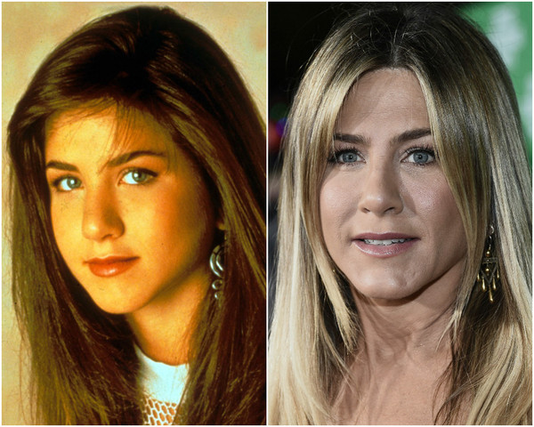 Комки Биша: удалять или нет Красота, Пластическая хирургия, Голливуд, Дженнифер, Adele, Анджелина Джоли, Длиннопост