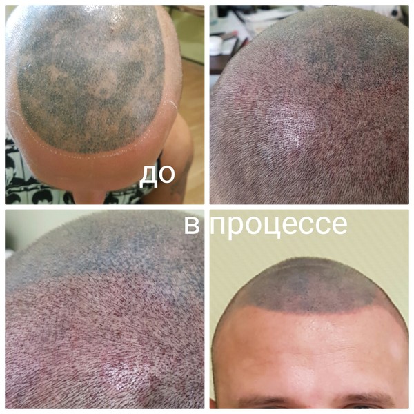 The story of my struggle with baldness, or what is trichopigmentation - My, Baldness, Tattoo, Trichopigmentation, Fight, Story, Video, Longpost