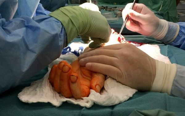 Polish surgeons perform groundbreaking hand transplant - Doctors, Surgeon, Breakthrough, The medicine, Longpost