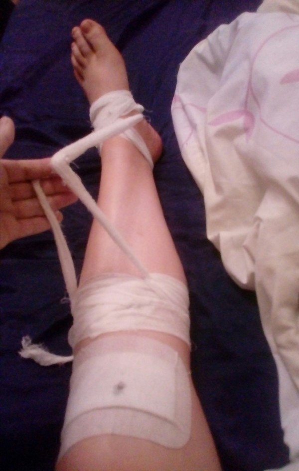 And with a slight movement of the hand, the leg turns into an elegant bag. - My, Operation, Legs, Arthroscopy, Bandages