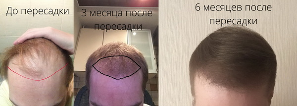 How I did a hair transplant and the result after 6 months. - My, Hair, Hair Transplant, Baldness, , Video, Longpost