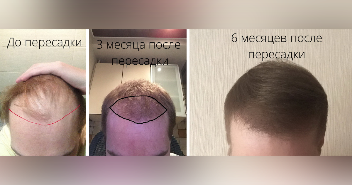 После месяца. Месяц после пересадки волос. Волосы спустя месяц после пересадки. Три месяца после пересадки волос. Пересадка волос месяц спустя.