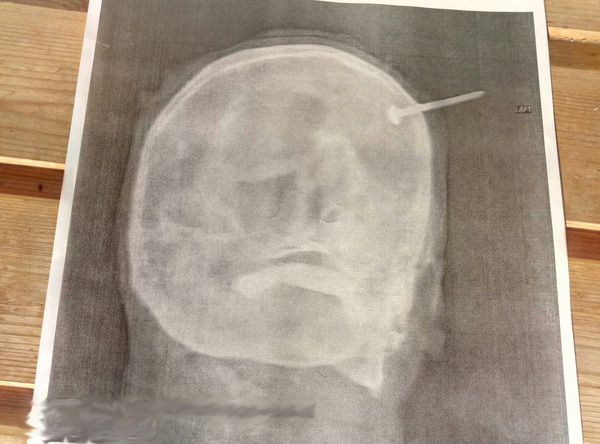 A friend of mine is a doctor, and this is what I found in her office. The head of the nail pierced the head, terribly. Be careful! - My, The patients, Hospital, Injury