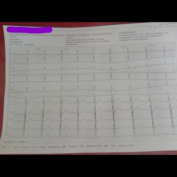 Please help cardiologists! - My, ECG, Cardiology