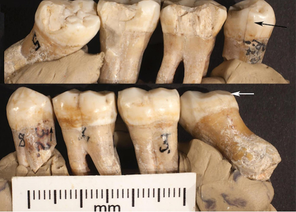 Neanderthals suspected of inventing dental tools - The science, news, Paleontology, Neanderthal, Dentistry