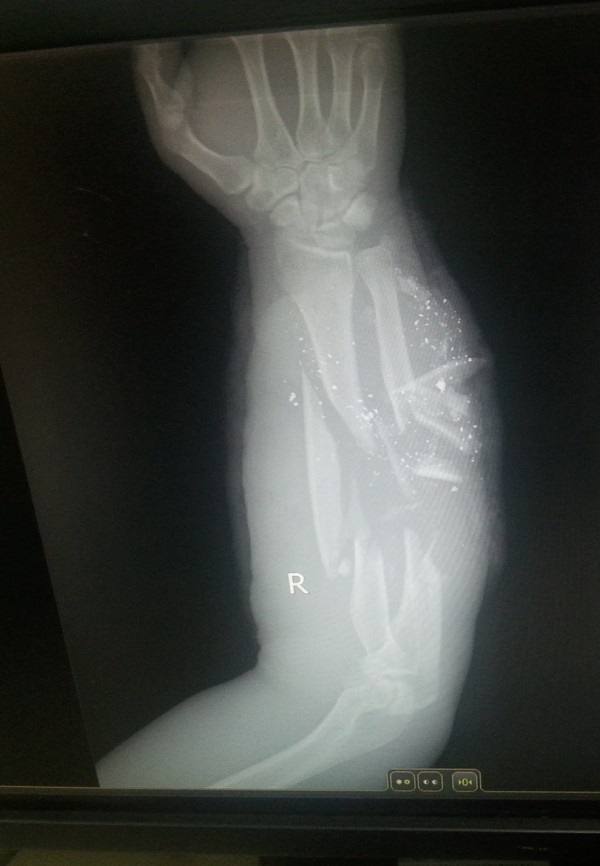 Fuck what a comminuted fracture of the bones of the forearm - Traumatology, The medicine, Fracture, Breaking, Longpost, Radiology