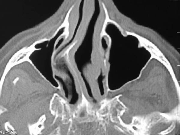 How did they fix my nasal septum? - My, The medicine, Lore, Nose, Operation, Text, Longpost, ENT-Doctors