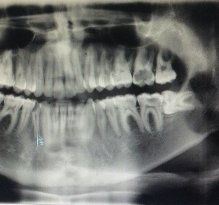 Snapshot of the jaw - My, Dentist, Wisdom tooth