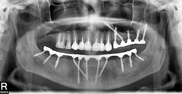 Basal implantation or ALDP* - My, Dentistry, Implantation, Teeth, Longpost