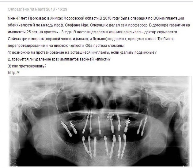 Basal implantation or ALDP* - My, Dentistry, Implantation, Teeth, Longpost