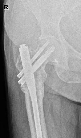 From the life of a radiologist. Part 1. - My, Radiology, Sos, Osteosynthesis, Longpost, The medicine