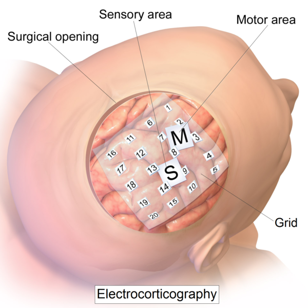 Neuralink Elon Musk. Part Two: Flying Over the Nest of Neurons - Elon Musk, Spacex, Tesla, Hi-Tech, Neuralink, Technologies, New technologies, Brain, Longpost