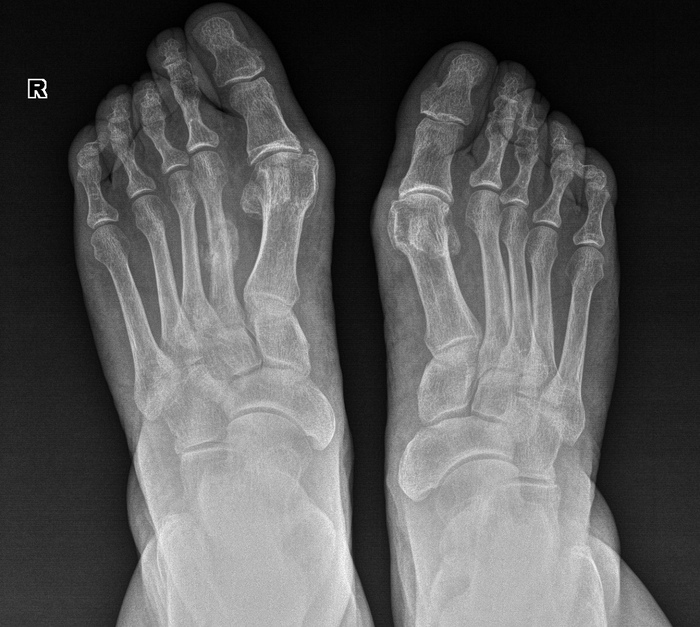 Фото ноги рентген снимок