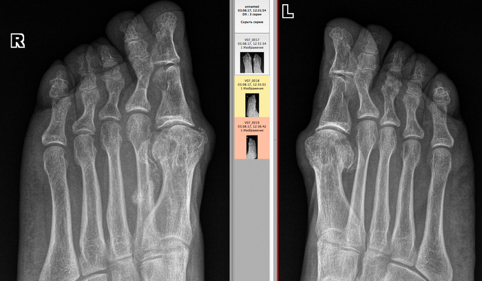 Рентген снимки переломов ног thumbnail