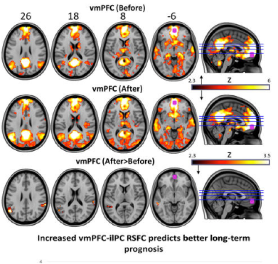 Hallucinogenic mushrooms have been shown to be effective in persistent depression - Research, Depression, Clinical trials, The medicine, Psilocybin, Miracle Mushrooms, Health, Benefit, Longpost