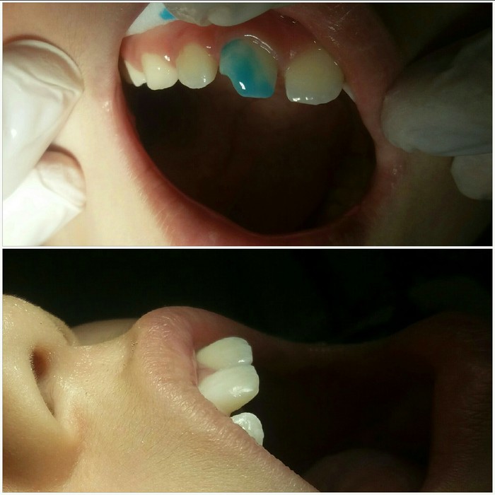 Broken tooth, what to do? - My, Dentistry, Teeth, Breaking